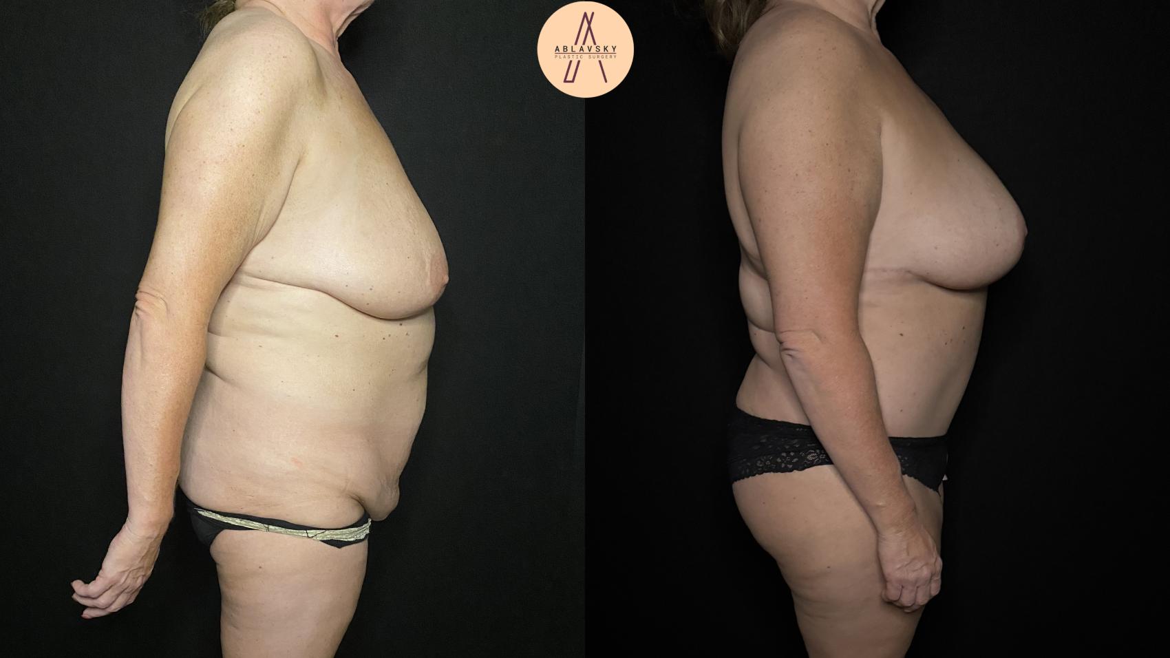 Before & After Tummy Tuck Case 338 Right Side View in San Antonio, Texas