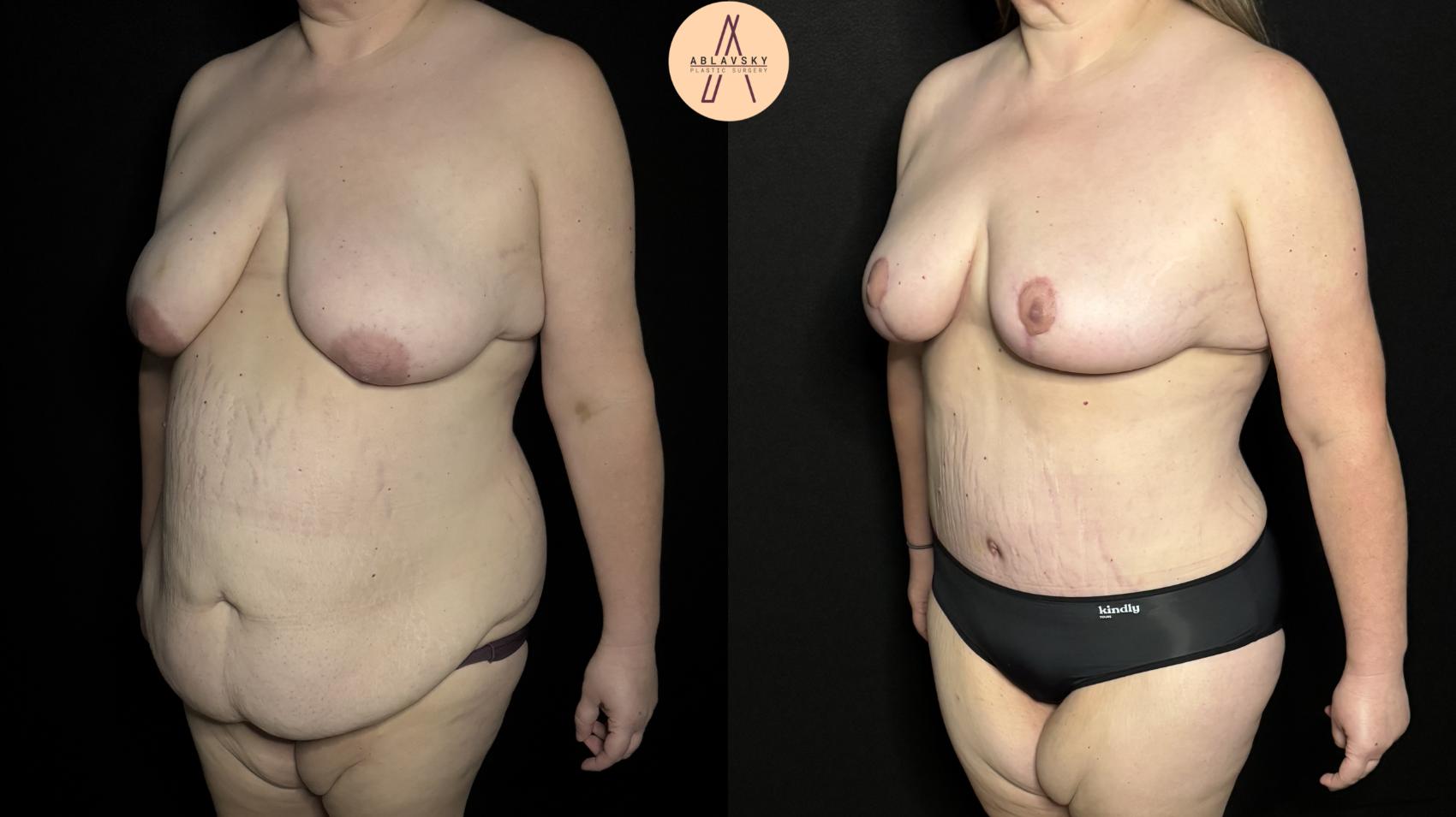 Before & After Mommy Makeover Case 339 Left Oblique View in San Antonio, Texas