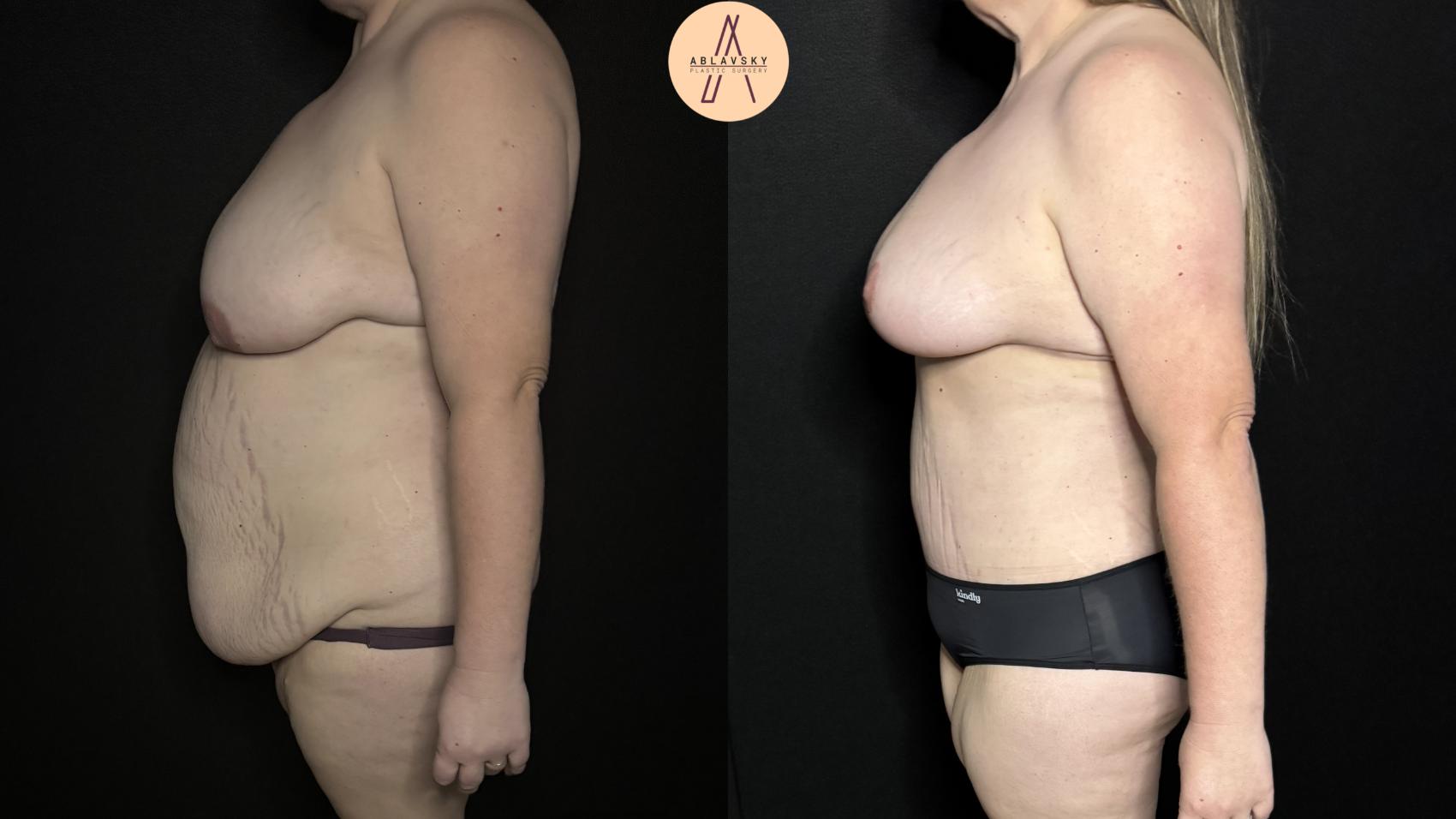 Before & After Mommy Makeover Case 339 Left Side View in San Antonio, Texas