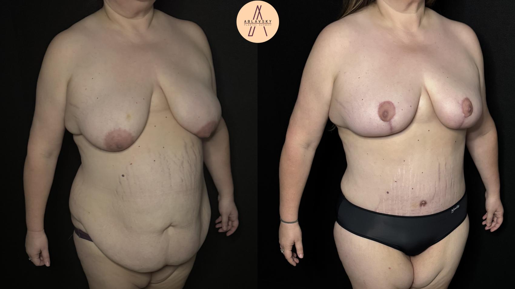 Before & After Mommy Makeover Case 339 Right Oblique View in San Antonio, Texas