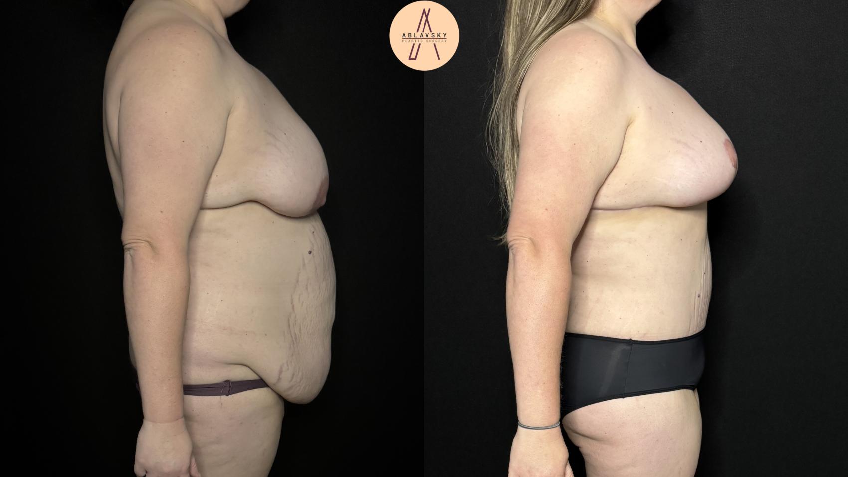 Before & After Mommy Makeover Case 339 Right Side View in San Antonio, Texas