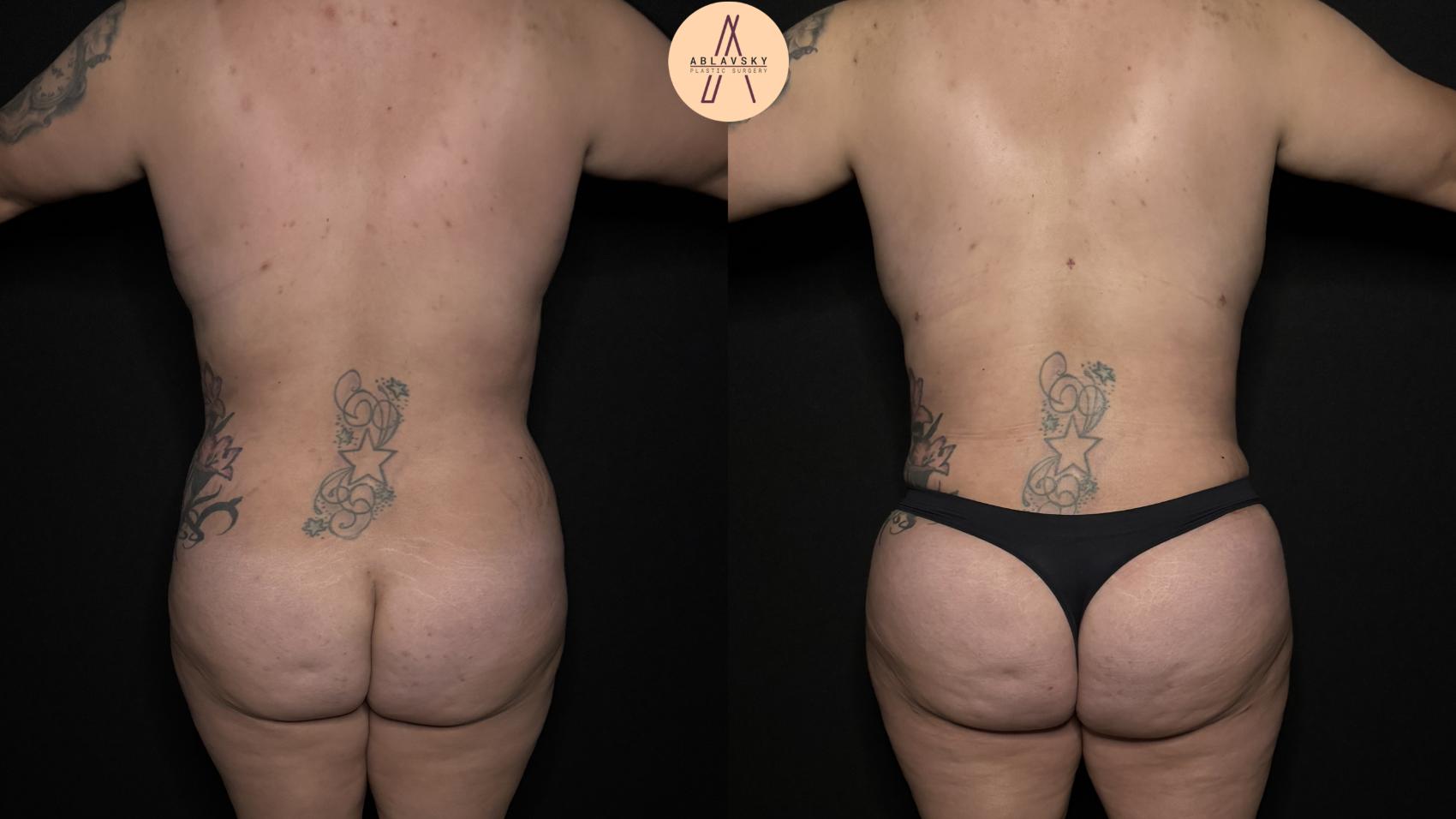 Before & After Breast Lift Case 350 Back View in San Antonio, Texas