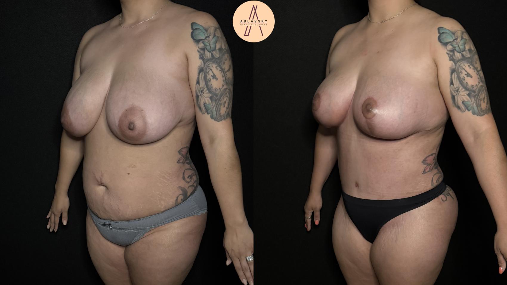 Before & After Breast Lift Case 350 Left Oblique View in San Antonio, Texas
