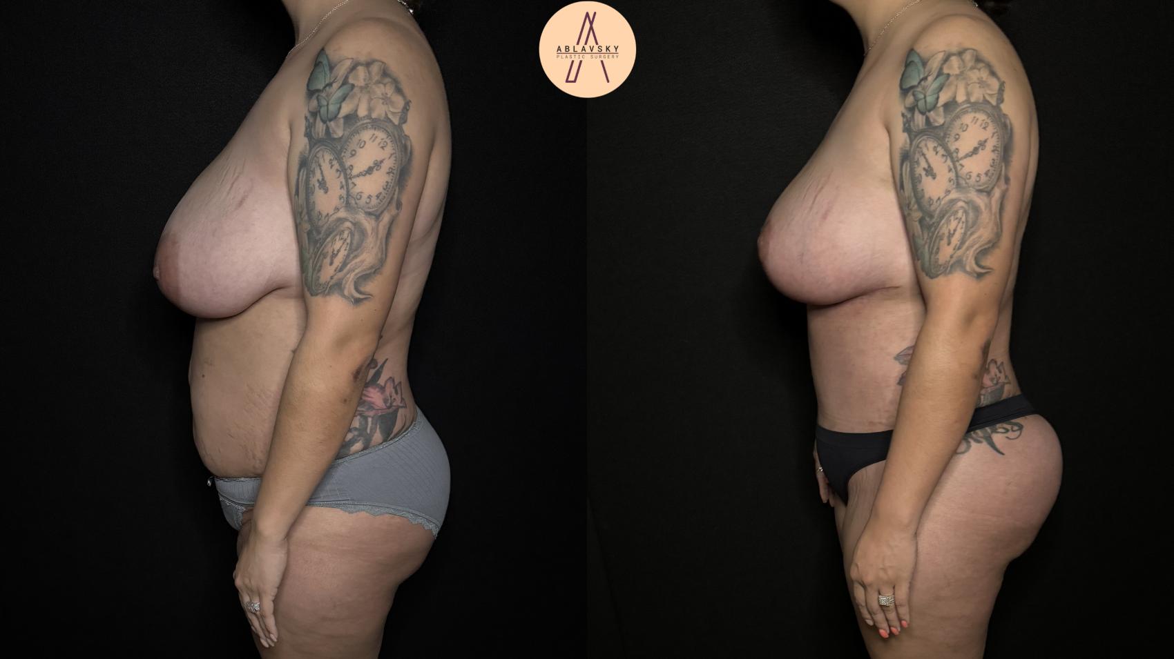 Before & After Breast Lift Case 350 Left Side View in San Antonio, Texas