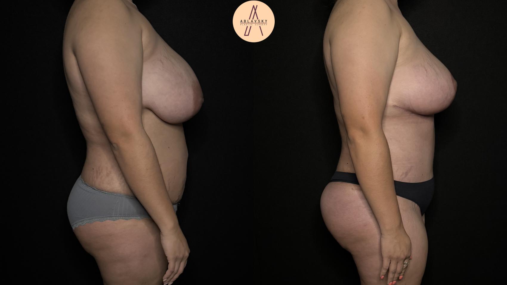 Before & After Breast Lift Case 350 Right Side View in San Antonio, Texas