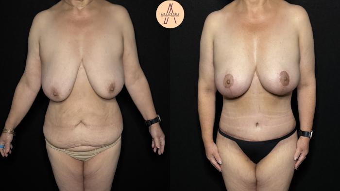 Before & After Mommy Makeover Case 366 Front View in San Antonio, Texas
