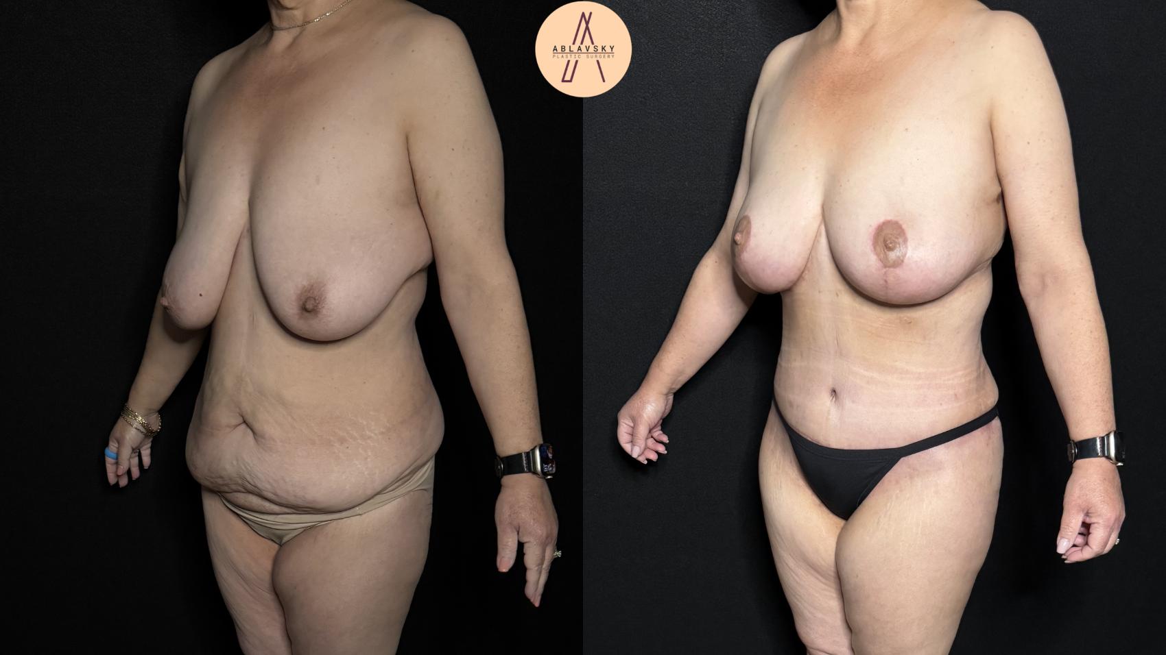 Before & After Breast Lift Case 366 Left Oblique View in San Antonio, Texas
