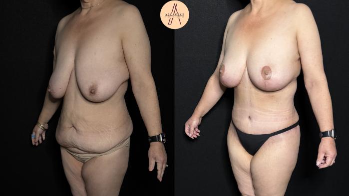 Before & After Mommy Makeover Case 366 Left Oblique View in San Antonio, Texas