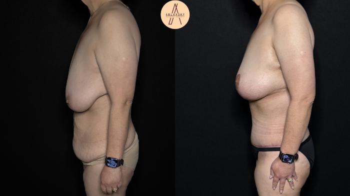 Before & After Mommy Makeover Case 366 Left Side View in San Antonio, Texas
