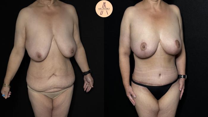 Before & After Mommy Makeover Case 366 Right Oblique View in San Antonio, Texas