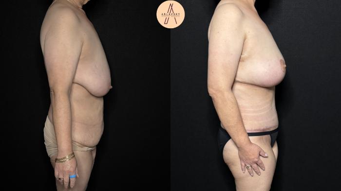 Before & After Mommy Makeover Case 366 Right Side View in San Antonio, Texas
