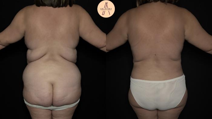 Before & After Mommy Makeover Case 367 Back View in San Antonio, Texas