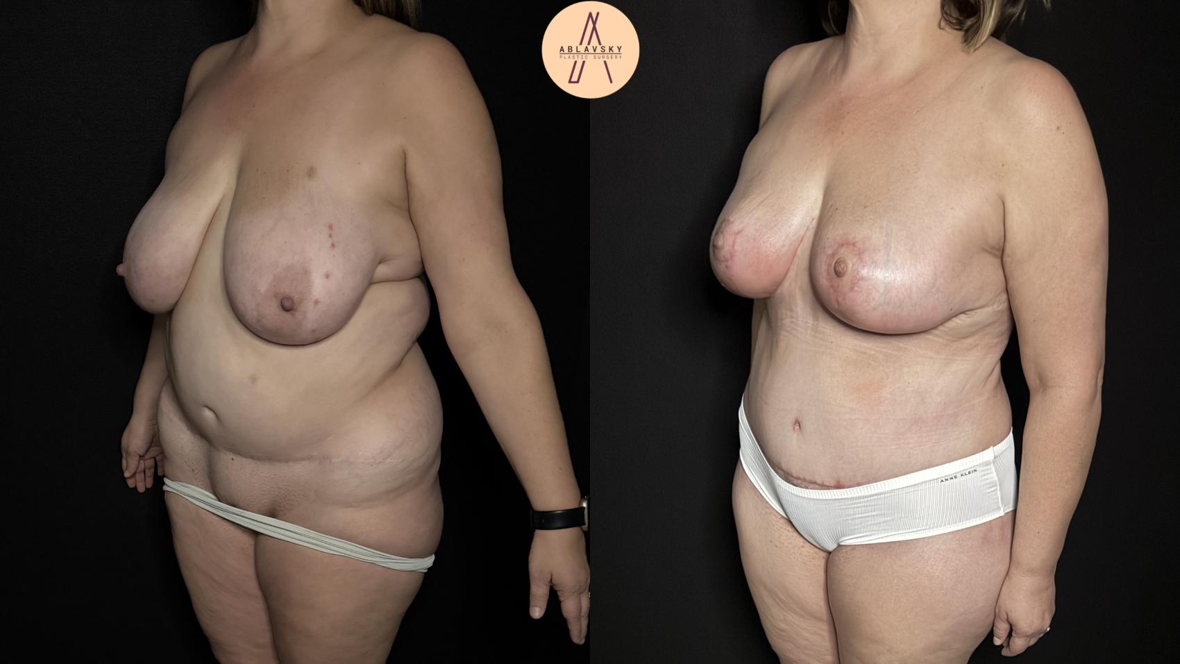 Before & After Liposuction Case 367 Left Oblique View in San Antonio, Texas