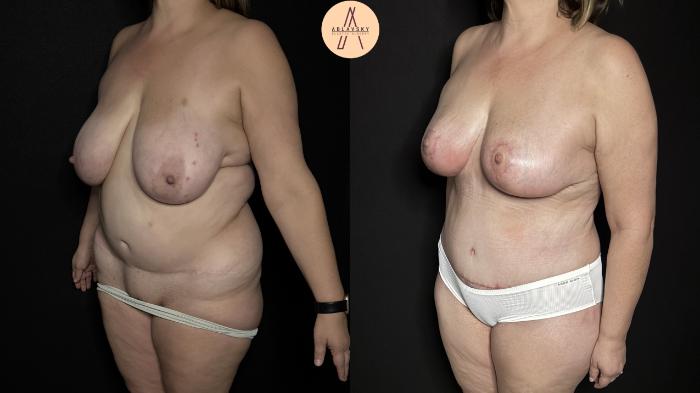 Before & After Mommy Makeover Case 367 Left Oblique View in San Antonio, Texas