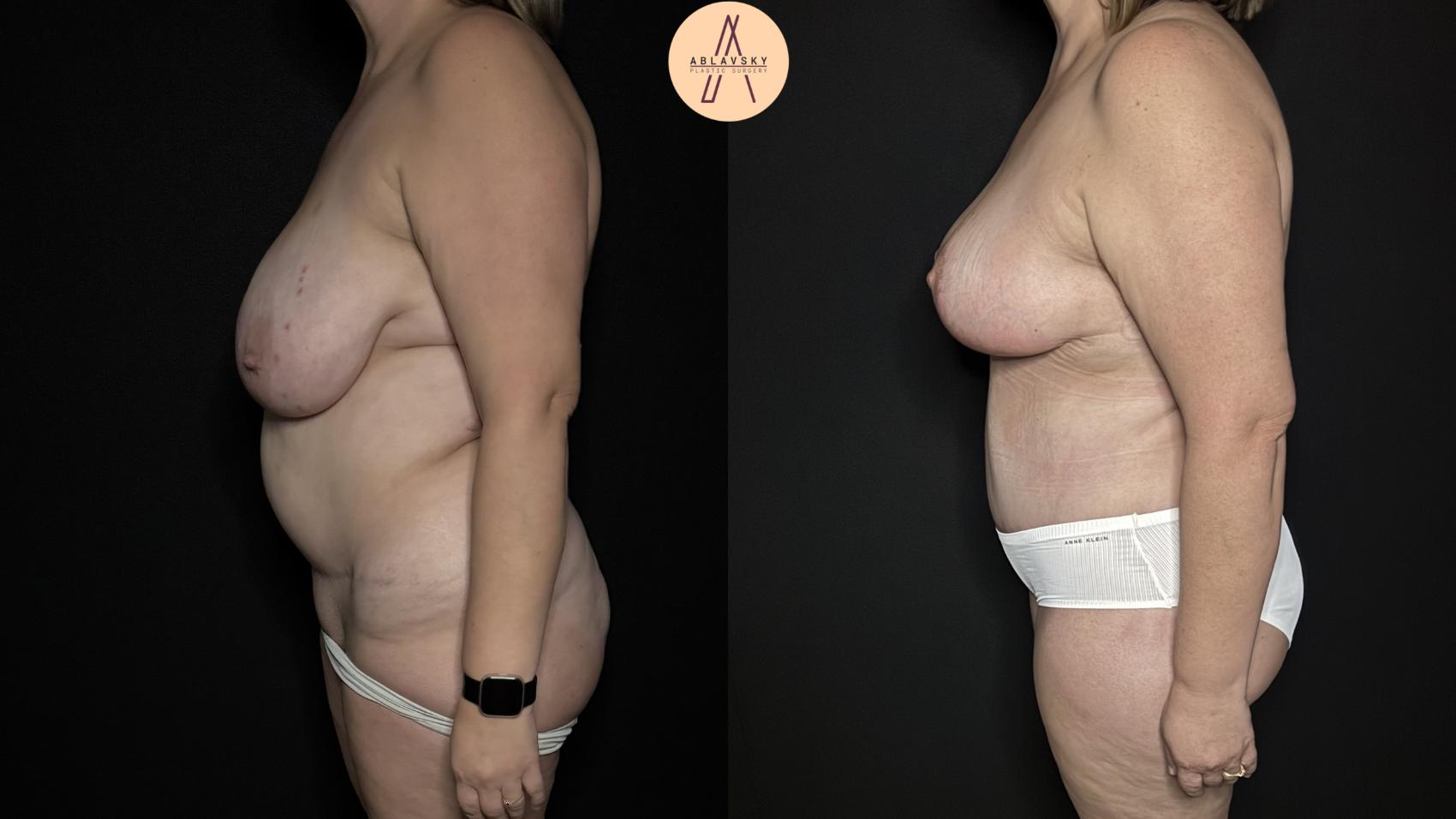 Before & After Liposuction Case 367 Left Side View in San Antonio, Texas