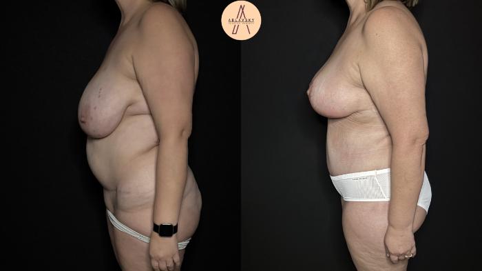 Before & After Mommy Makeover Case 367 Left Side View in San Antonio, Texas
