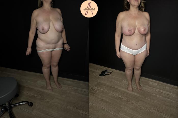 Before & After Mommy Makeover Case 367 Right Oblique View in San Antonio, Texas