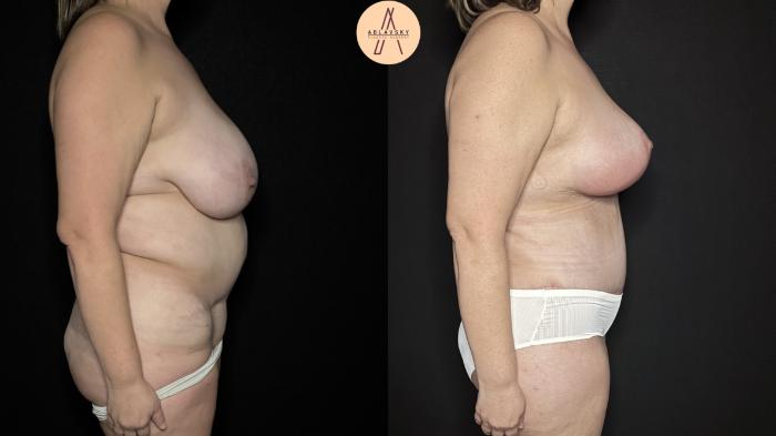 Before & After Mommy Makeover Case 367 Right Side View in San Antonio, Texas