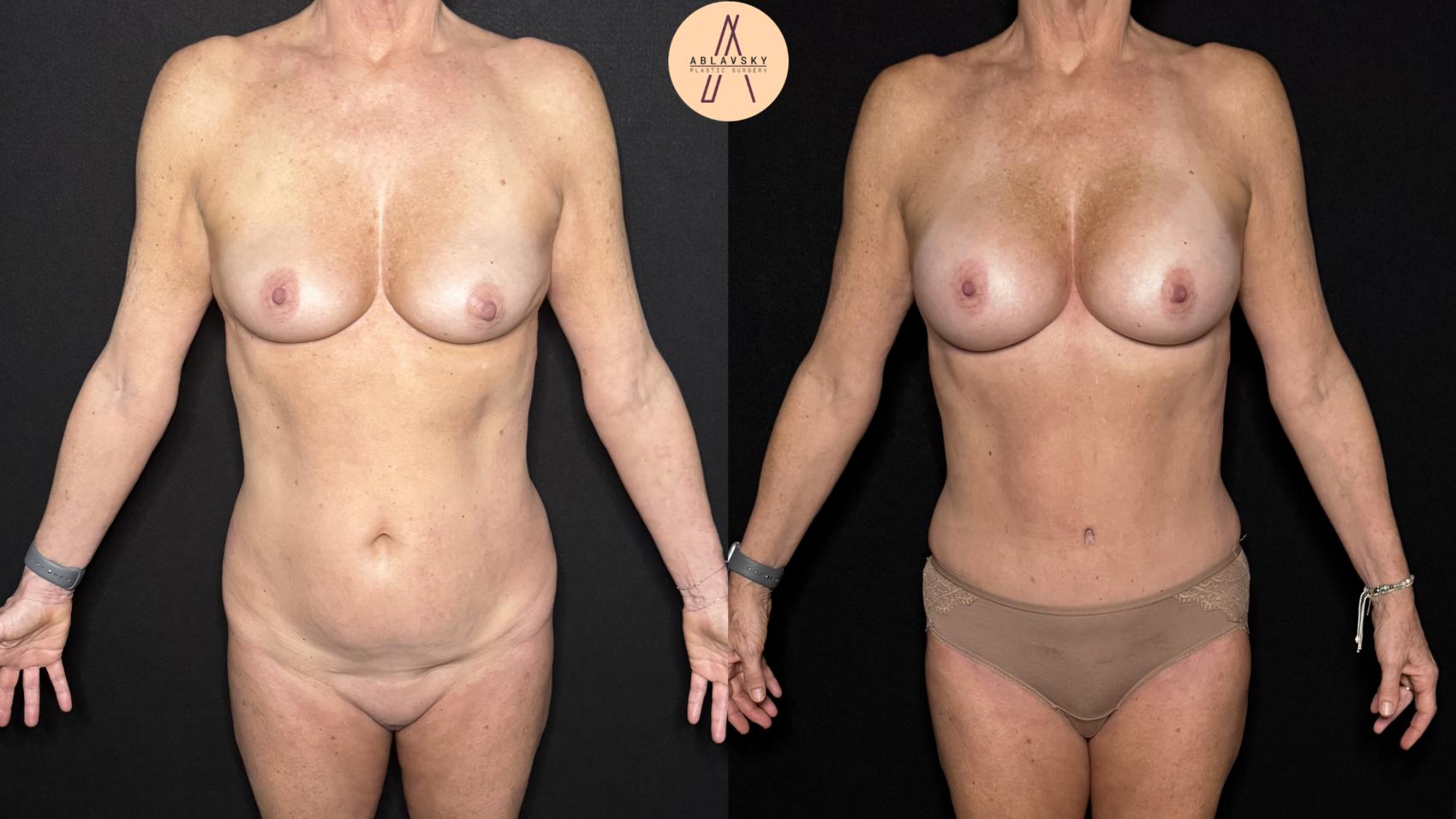 Before & After Liposuction Case 376 Front View in San Antonio, Texas