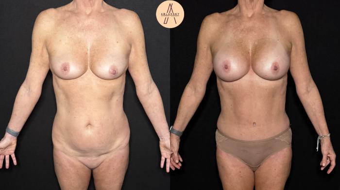 Before & After Liposuction Case 376 Front View in San Antonio, Texas