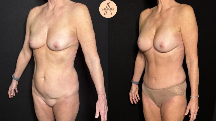 Before & After Liposuction Case 376 Left Oblique View in San Antonio, Texas