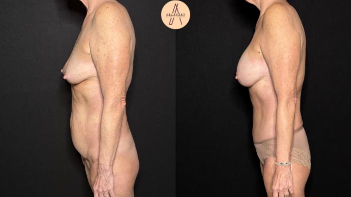 Before & After Liposuction Case 376 Left Side View in San Antonio, Texas