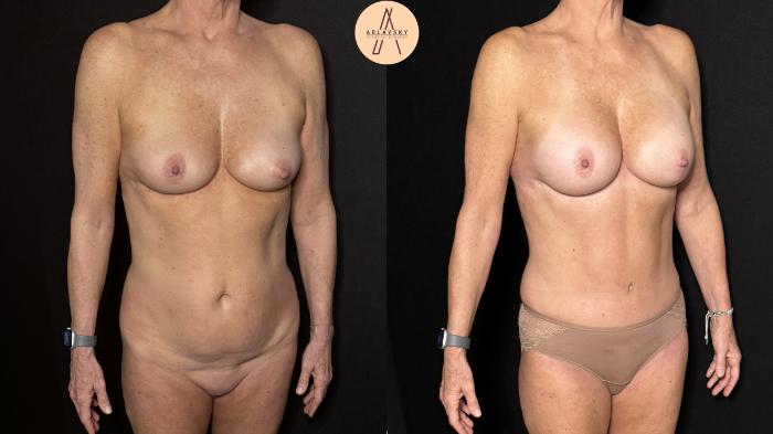 Before & After Liposuction Case 376 Right Oblique View in San Antonio, Texas