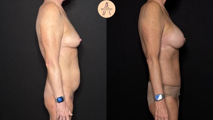 Before & After Liposuction Case 376 Right Side View in San Antonio, Texas