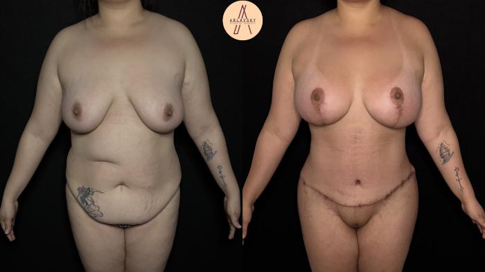 Before & After Mommy Makeover Case 379 Front View in San Antonio, Texas