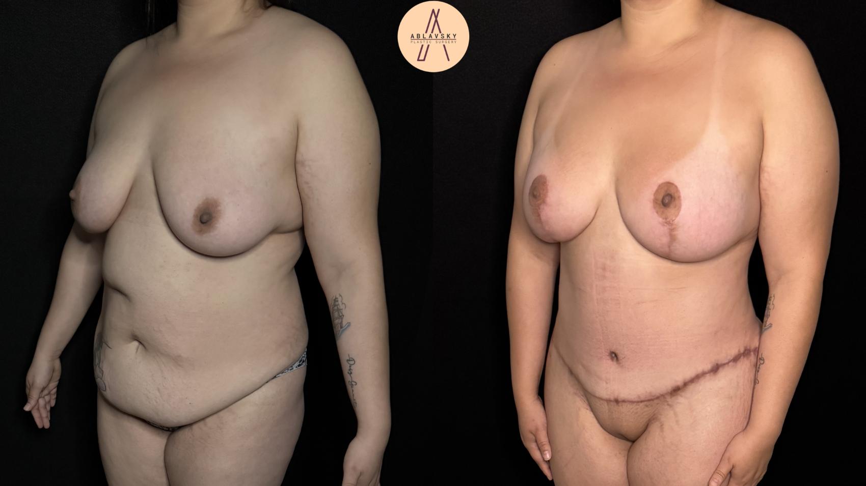 Before & After Mommy Makeover Case 379 Left Oblique View in San Antonio, Texas