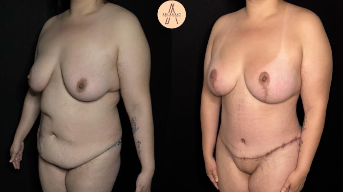 Before & After Mommy Makeover Case 379 Left Oblique View in San Antonio, Texas