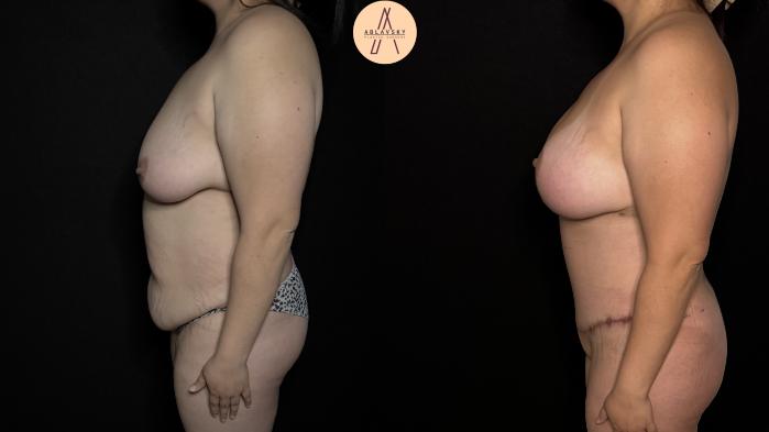 Before & After Mommy Makeover Case 379 Left Side View in San Antonio, Texas