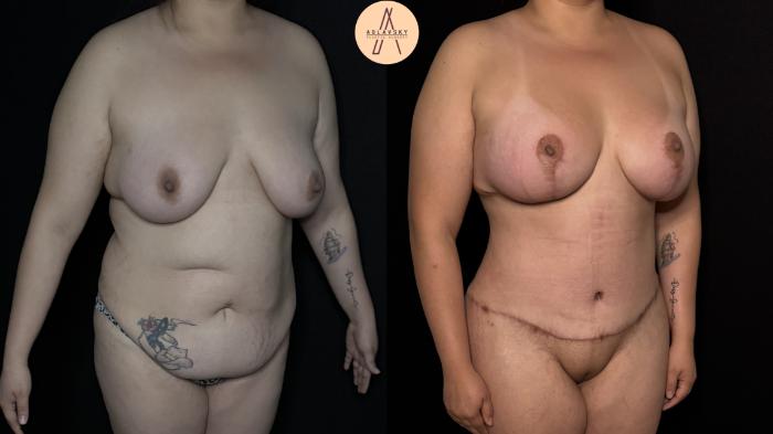 Before & After Mommy Makeover Case 379 Right Oblique View in San Antonio, Texas