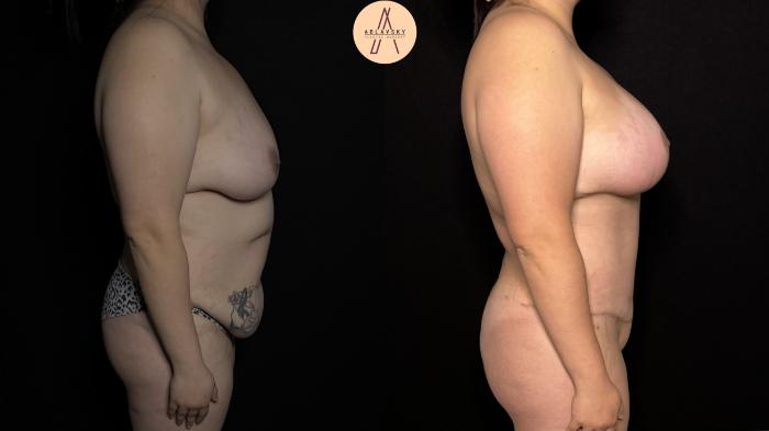 Before & After Mommy Makeover Case 379 Right Side View in San Antonio, Texas
