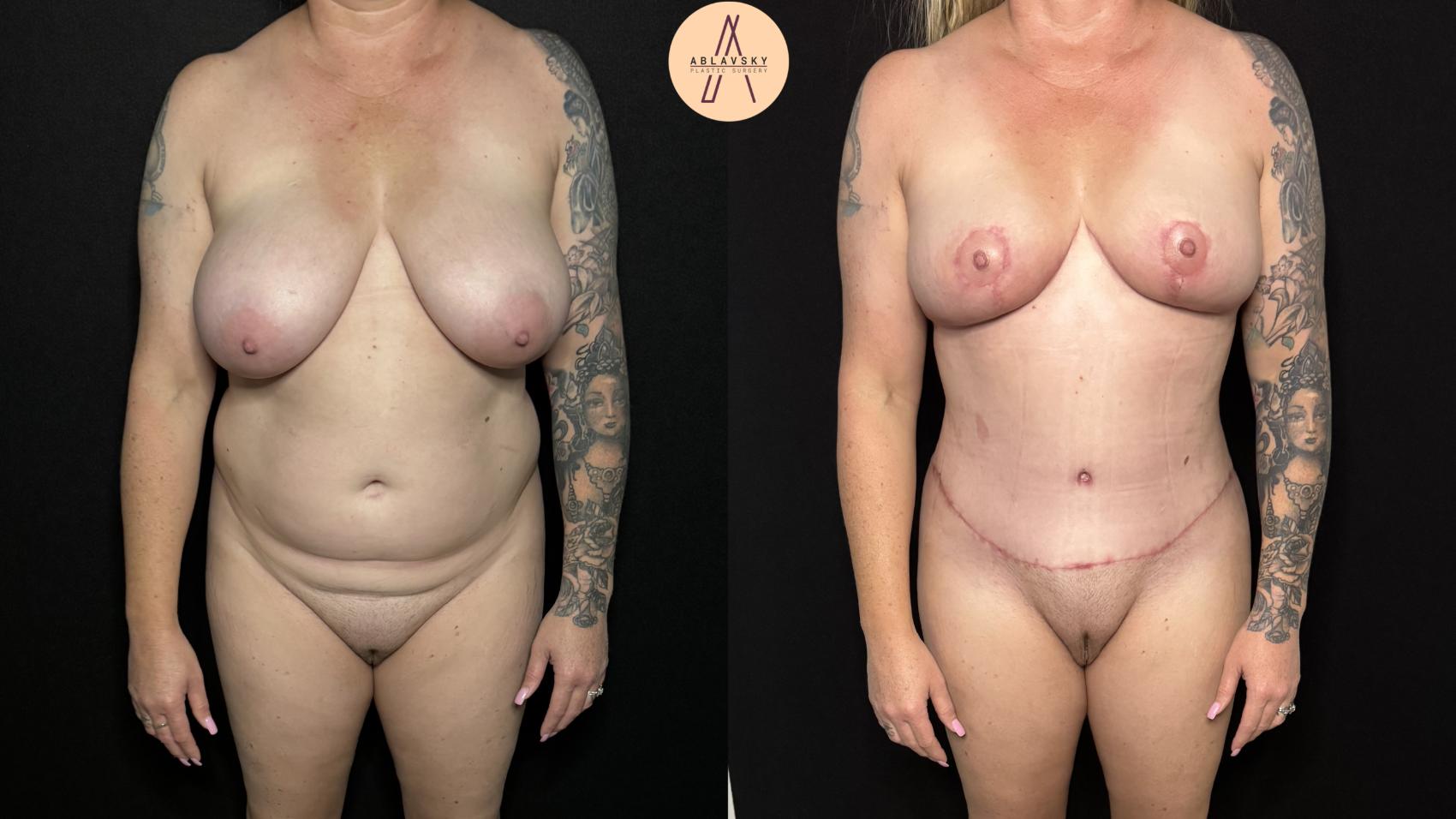 Before & After Mommy Makeover Case 401 Front View in San Antonio, Texas