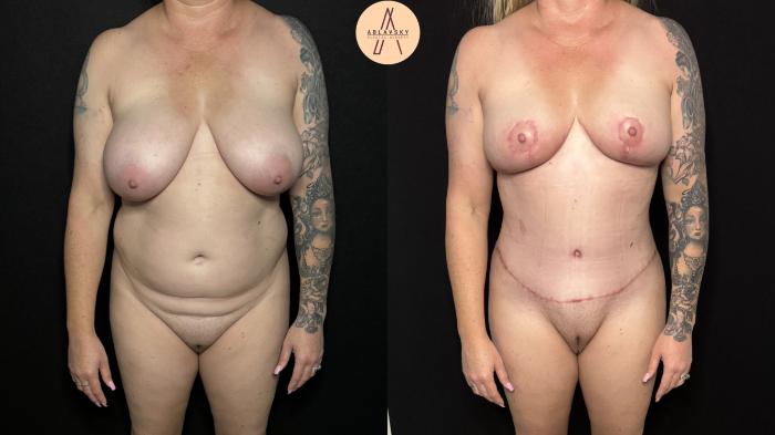 Before & After Mommy Makeover Case 401 Front View in San Antonio, Texas