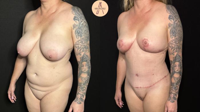 Before & After Mommy Makeover Case 401 Left Oblique View in San Antonio, Texas