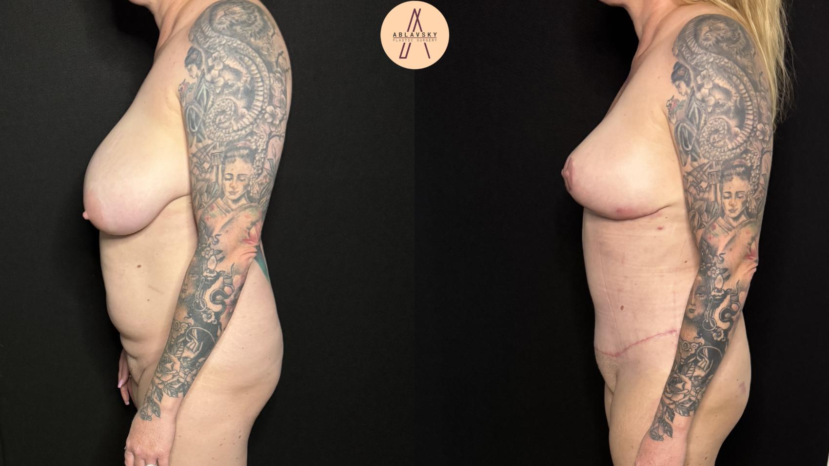 Before & After Mommy Makeover Case 401 Left Side View in San Antonio, Texas