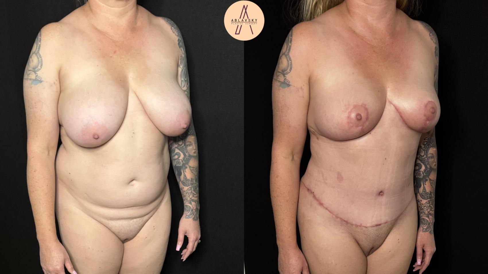 Before & After Mommy Makeover Case 401 Right Oblique View in San Antonio, Texas