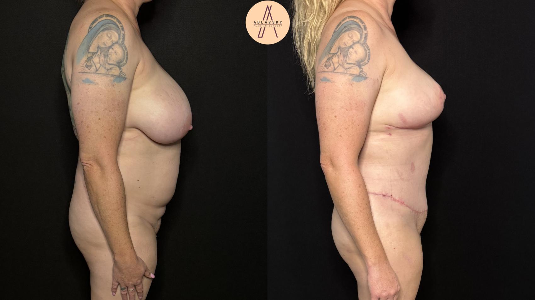 Before & After Mommy Makeover Case 401 Right Side View in San Antonio, Texas
