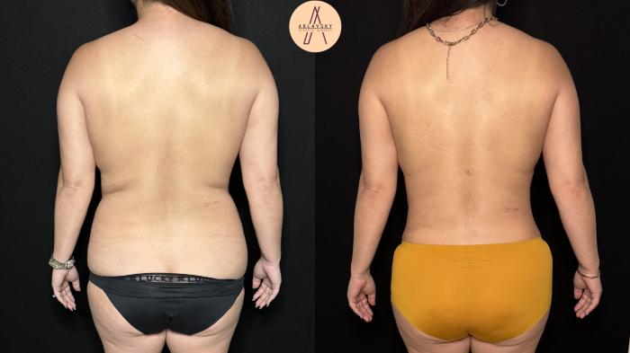 Before & After Liposuction Case 403 Back View in San Antonio, Texas