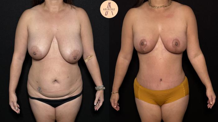 Before & After Liposuction Case 403 Front View in San Antonio, Texas