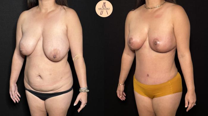 Before & After Liposuction Case 403 Left Oblique View in San Antonio, Texas