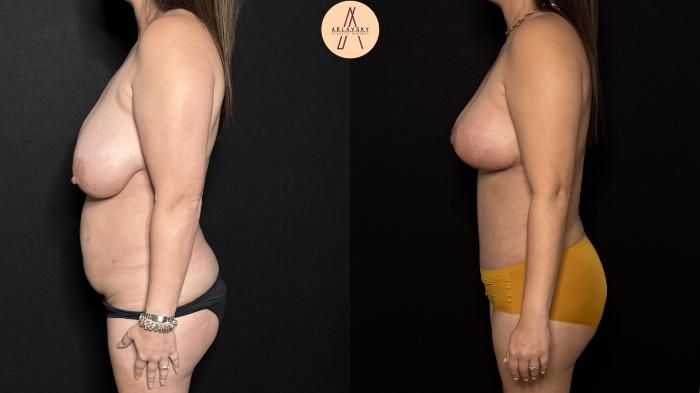 Before & After Liposuction Case 403 Left Side View in San Antonio, Texas