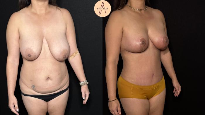 Before & After Liposuction Case 403 Right Oblique View in San Antonio, Texas