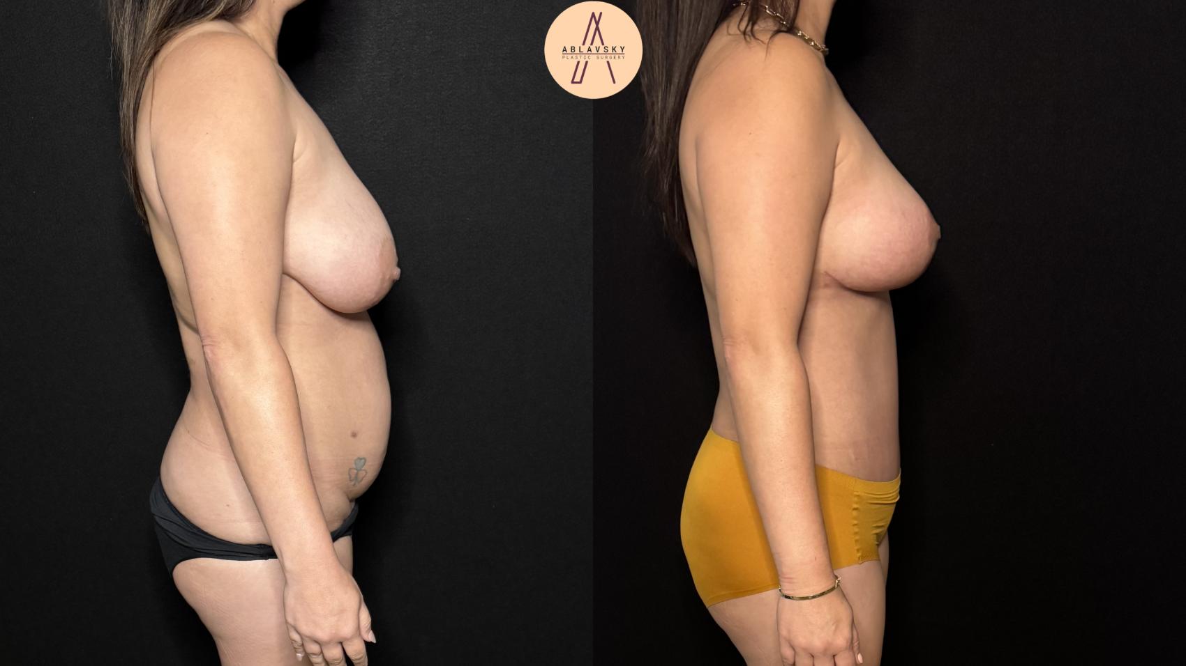 Before & After Liposuction Case 403 Right Side View in San Antonio, Texas