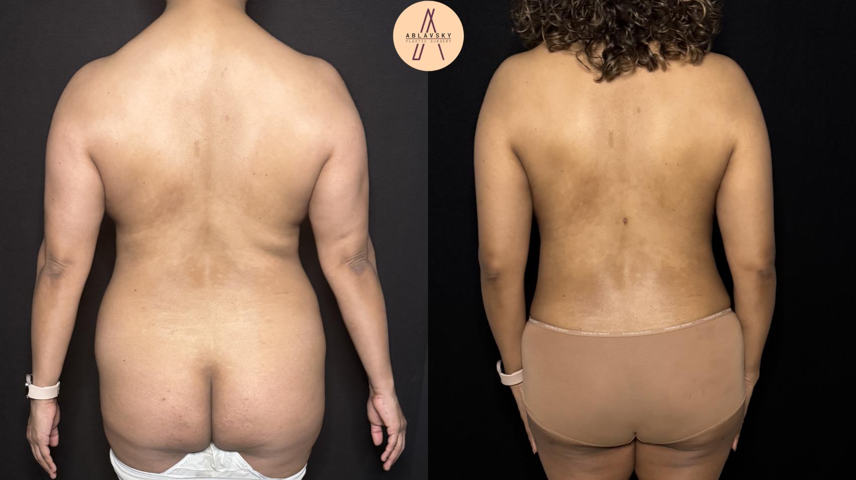 Before & After Mommy Makeover Case 404 Back View in San Antonio, Texas