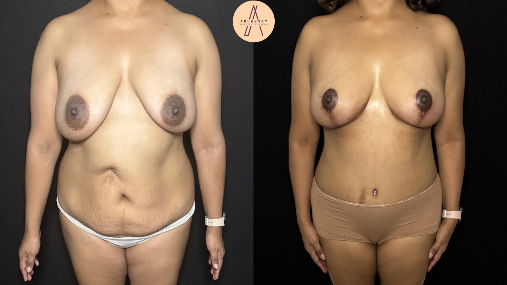 Before & After Mommy Makeover Case 404 Front View in San Antonio, Texas