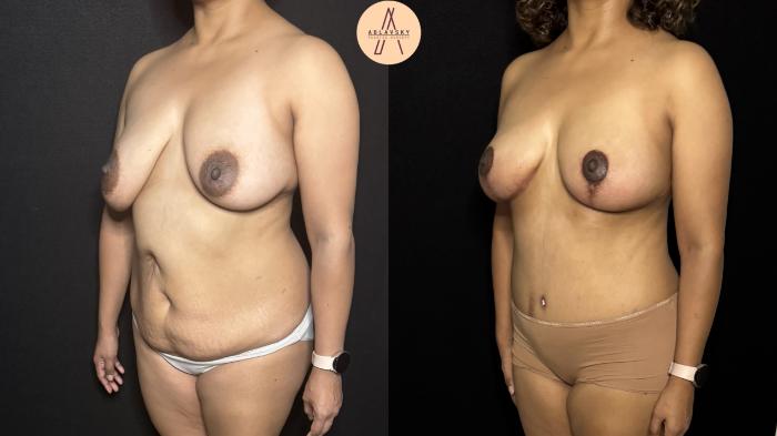 Before & After Mommy Makeover Case 404 Left Oblique View in San Antonio, Texas