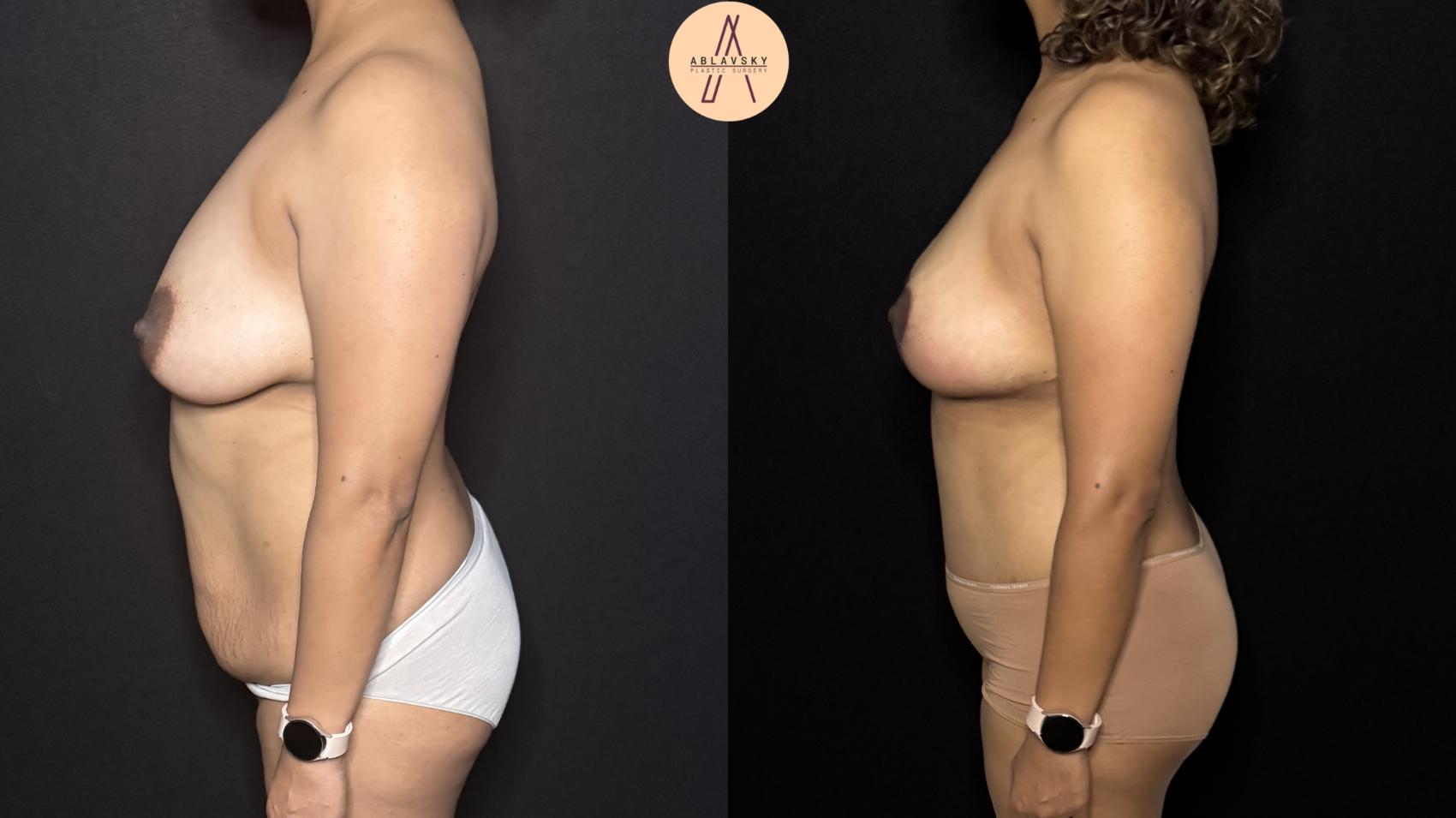 Before & After Mommy Makeover Case 404 Left Side View in San Antonio, Texas